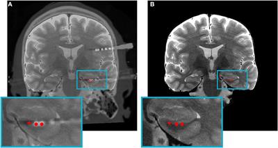 Reporting Guidelines and Issues to Consider for Using Intracranial Brain Stimulation in Studies of Human Declarative Memory